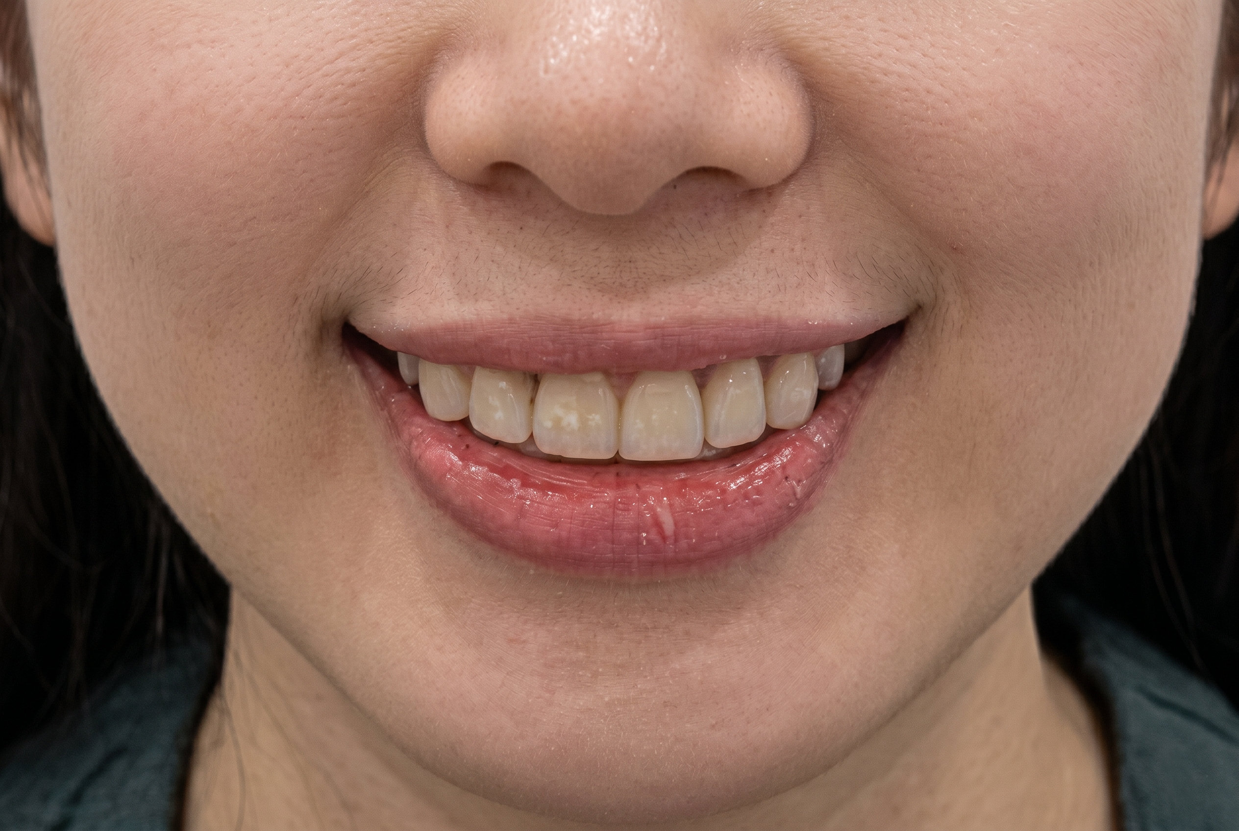 Smile Makeover - After